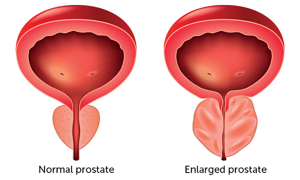 Castrate Resistant Prostate Cancer
