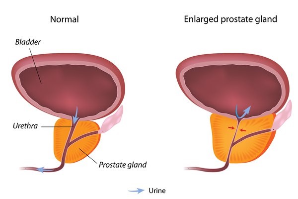 Prostate Cancer and Enlarged Prostate – Causes, Symptoms & Prevention
