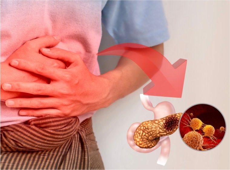 Gallstone Risk and Treatments