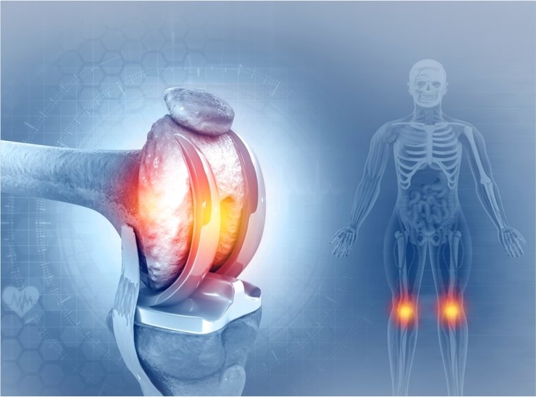 Most Patients Don’t Realize They Have Bone Loss Until They Break a Bone